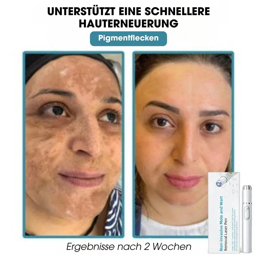 DermaLight Pro™ – Non-Invasive Laser Pen for Moles, Warts & Skin Tags