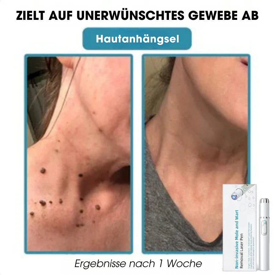 DermaLight Pro™ – Non-Invasive Laser Pen for Moles, Warts & Skin Tags