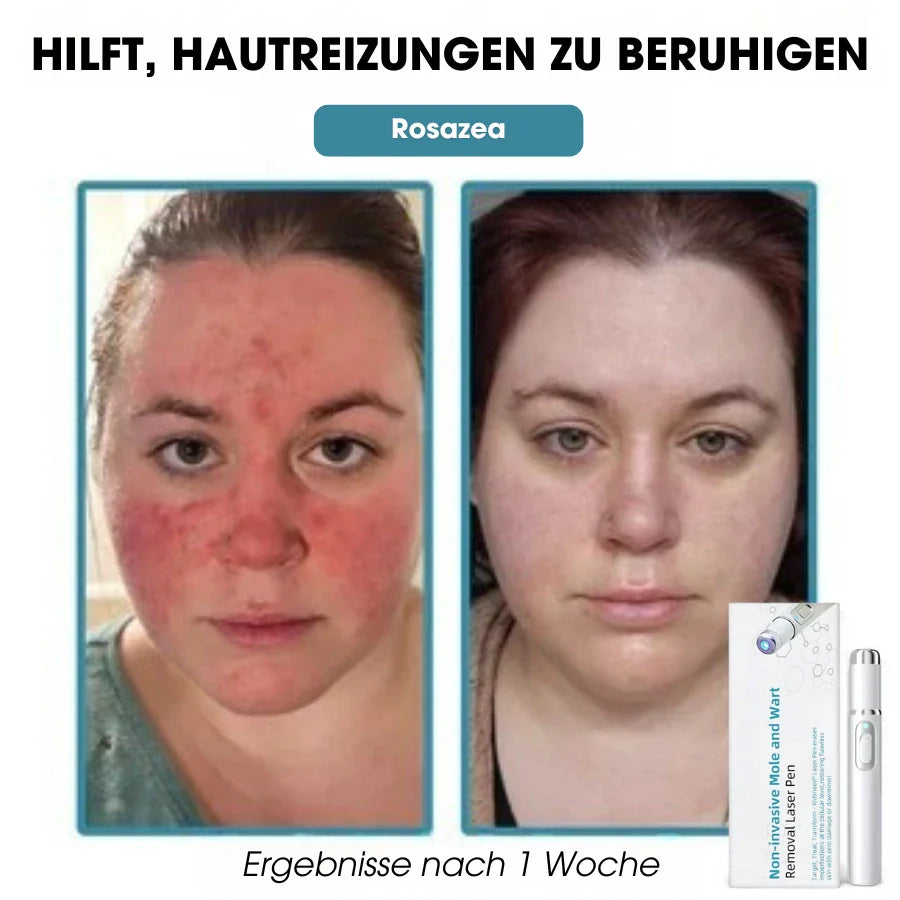DermaLight Pro™ – Non-Invasive Laser Pen for Moles, Warts & Skin Tags