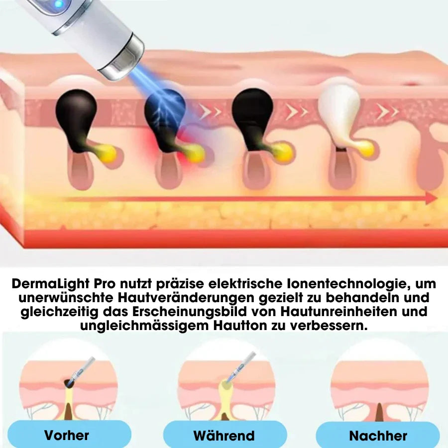 DermaLight Pro™ – Non-Invasive Laser Pen for Moles, Warts & Skin Tags