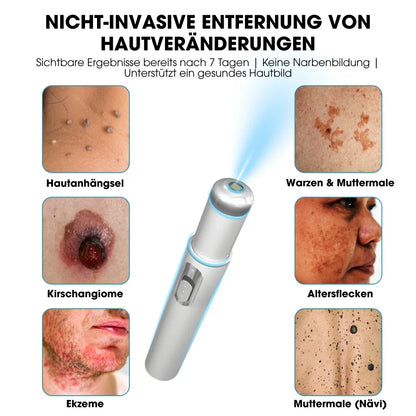 DermaLight Pro™ – Non-Invasive Laser Pen for Moles, Warts & Skin Tags