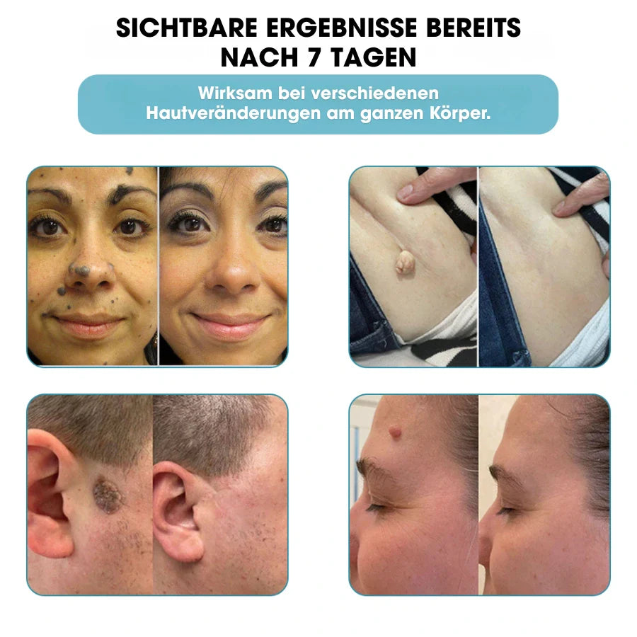 DermaLight Pro™ – Non-Invasive Laser Pen for Moles, Warts & Skin Tags