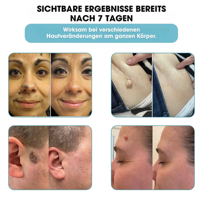 DermaLight Pro™ – Non-Invasive Laser Pen for Moles, Warts & Skin Tags